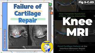 Fig 5C03 Illustrations of Cartilage Repair Failure [upl. by Kraft106]