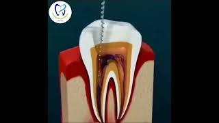 Root Canal Treatment Step by Step Animation [upl. by Anaerdna]