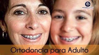 Ortodoncia para adultos [upl. by Colis]