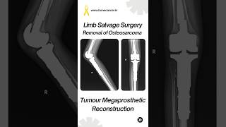 Treatment of Pediatric Bone Cancer Limb Saving Surgery by Dr Srimanth B S amp Team cancer sarcoma [upl. by Oralee]