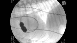 Percutaneous balloon pulmonary valvuloplasty in dog  Pulmonary Valve Stenosis [upl. by Gerianne]