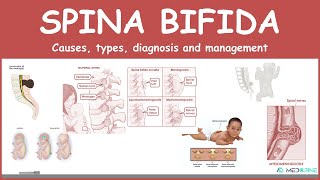 Spina bifida Types myelomeningocele meningocele occulta  causes symptoms diagnosis treatment [upl. by Brianna]