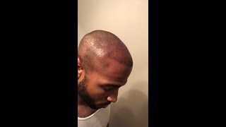 Bosley  FUE  African American Hair transplant  My story to hair loss\ journey [upl. by Jeb]