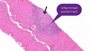 Histology of Primary Biliary Cholangitis [upl. by Fidela]