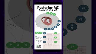 Posterior MI Leads V7 V8 amp V9 REBELEM ECG EKG PosteriorMI [upl. by Aihseuqal746]