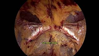 Laparoscopic bilateral TEP with plication of Pseudosac [upl. by Inaluahek]