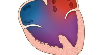 Hydrops fetalis because of cardiac anomaly  Atrioventricular septal defects AVSDs [upl. by Akimed]