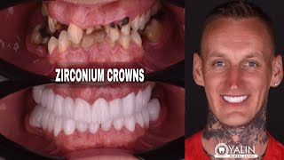 ZIRCONIUM CROWNS TREATMENTS  SMILE MAKEOVER IN ANTALYA TURKEY [upl. by Ainekahs]