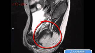 Caudal regression syndrome [upl. by Bunni]