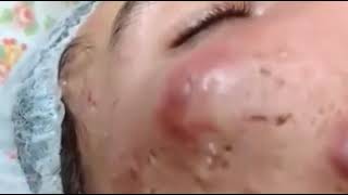 Big Acne Pus on face pop out Really hurt and terrified [upl. by Atinwahs]