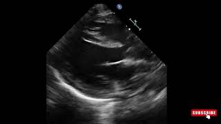 Overriding aorta in tetralogy of Fallot  Echo [upl. by Happ]