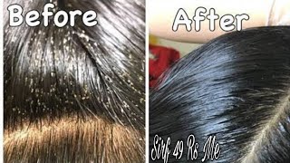 Remove 100 Lice amp Eggs Permanently with Hair Sheild Anti lice Cream 49 Rs  Farha KHan [upl. by Sparke939]