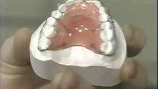 Diastema Closure  Hawley Retainer [upl. by Ellirehs]