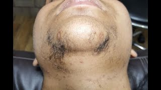 Remove Unwanted Hair PERMANENTLY  DTC skin clinic Dr Rohit Goel MD GIADA [upl. by Lainad485]