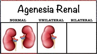 Agenesia Renal [upl. by Oflodor]