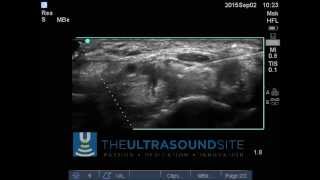 Ultrasound Guided Carpal tunnel injection [upl. by Adaj583]