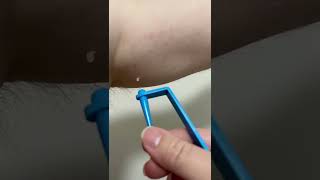 Removing skin tags at home [upl. by Enelak]