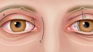 Lateral Orbitotomy avoided by performing Inferior Transconjunctival Orbitomy by Dr Akshay Nair [upl. by Wexler679]