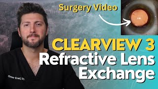 Refractive Lens Exchange RLE Surgery with the Clearview 3 Lens [upl. by Rochette]