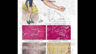 McArdle Disease type V glycogen storage disease [upl. by Nerrat]