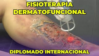 Diplomado Internacional en Fisioterapia Dermatofuncional [upl. by Narag]