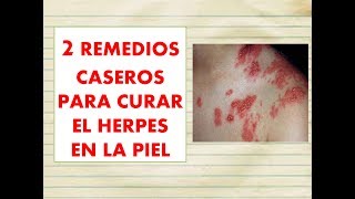 REMEDIOS CASEROS para CURAR el HERPES en la PIEL remedios caseros PARA EL HERPES ZOSTER o CULEBRILLA [upl. by Prosperus930]