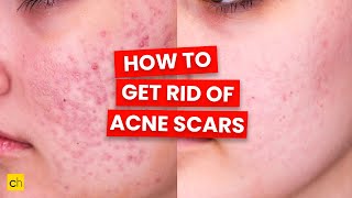 How To Get Rid of Acne Scars  Credihealth [upl. by Larine349]