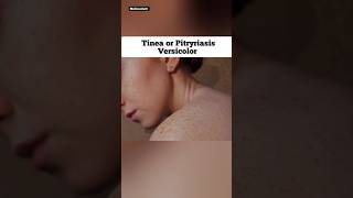 Tinea Versicolor  Pityriasis Versicolor [upl. by Ahsinrac958]