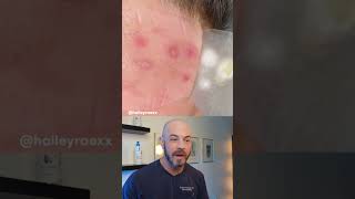 Derm reacts to satisfying hydrocolloid patch removal hydrocolloidpatch [upl. by Mik]