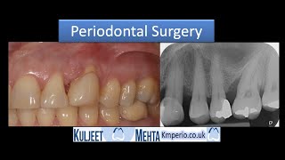 Periodontal Surgery with GTRBefore amp After 7 years [upl. by Assylla881]