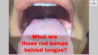 What are Red bumps behind Tongue  Taste Buds How to keep them clean and healthy [upl. by Anerual]