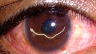 10 Worst Things That Can Happen to Your Eyes [upl. by Adnauqal871]