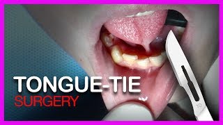 Tongue Tie SURGERY [upl. by Viradis]