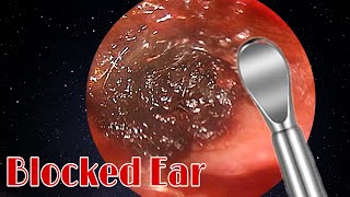 BIGGEST Ear Wax Difficult Removal  EP3  Doctor Anh [upl. by Hazard]