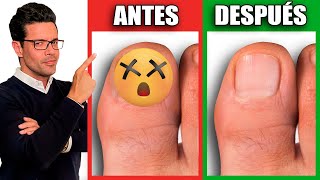 ¡Elimina HONGOS en las UÑAS en 1 DÍA  REMEDIOS NATURALES para HONGOS en las UÑAS [upl. by Areik973]