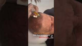 Haar Behandlung mit Mesotherapie oder PRP Eigenbluttherapie [upl. by Cruce44]