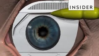 How LASIK Eye Surgery Is Performed [upl. by Ettelra954]