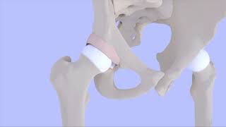 Femoroacetabular Impingement Syndrome [upl. by Hnilym]