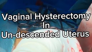 Vaginal Hysterectomy in Undescended uterus  Very important  Tips and Tricks  to make it Easy ⭐️⭐️ [upl. by Anirres945]