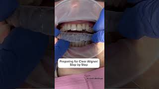 Preparing for Clear Aligners   invisalign aligners dentistdubai стоматолог [upl. by Mcgurn]