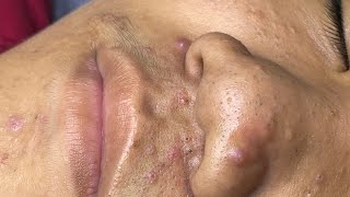 ACNE TREATMENT VU QUYNH MI Acne On Boys Nose 2024 [upl. by Aenit980]