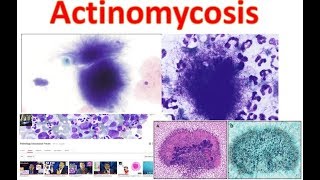 Actinomycosis Medschooltutorial [upl. by Patsis]