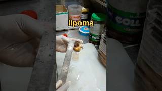 Lipoma tissue specimen [upl. by Clare]