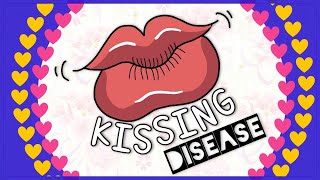 Infectious mononucleosis Kissing disease Diagnosis Clinical feature Treatment [upl. by Chiaki863]