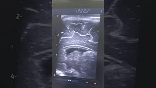 cranial ultrasound in full term neonates coronal and sagittal view neonates neonatology cranial [upl. by Carolle]