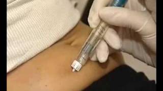 How correctly use multidose GONAL  F injection [upl. by Charmain]