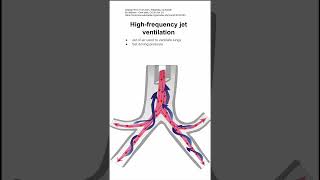 Highfrequency jet ventilation [upl. by Akierdna]