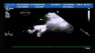 Hot Tips  Finding the Aortic Arch with Ultrasound [upl. by Rap]