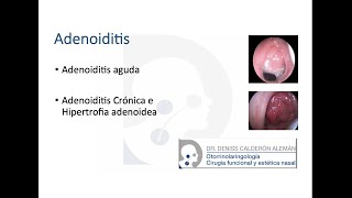 4 Adenoiditis [upl. by Jochbed]