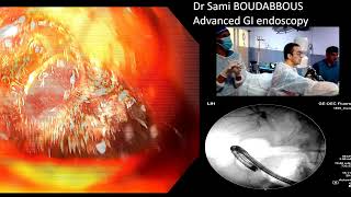 ERCP for severe acute cholangitis [upl. by Gney]